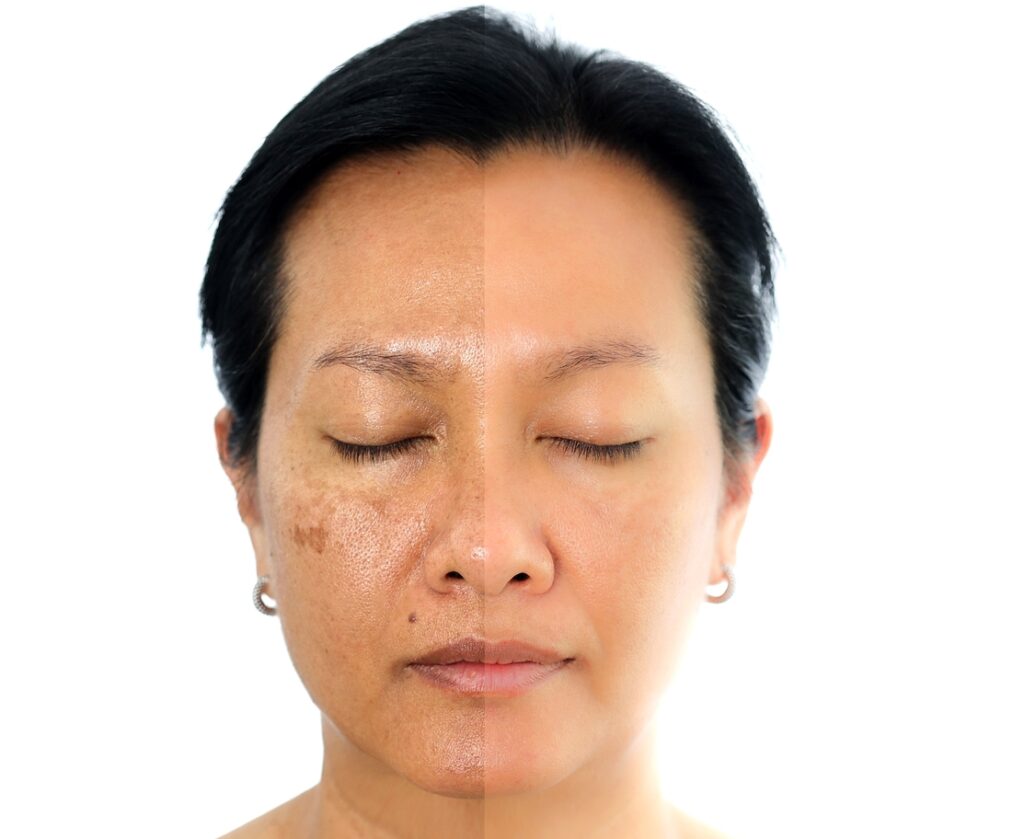 Sun Damage Treatment Sugar Land TX