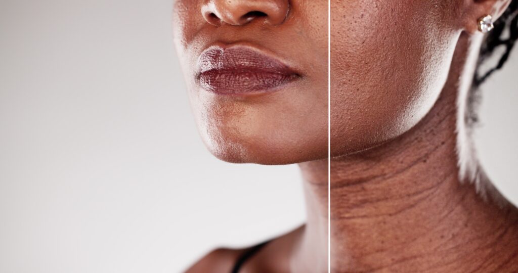 The,Transformation,Of,An,African,American,Woman's,Skin,Before,And Laser Skin Resurfacing Sugar Land TX