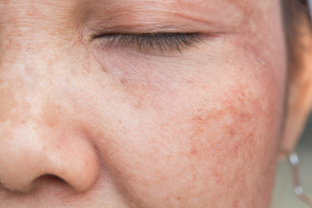 Age Spot Treatment Sugar Land TX
