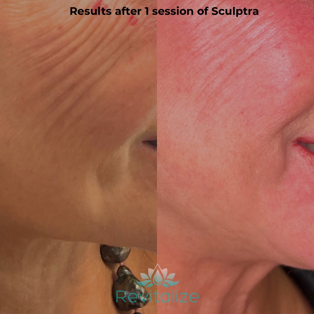 Before and After Image: Sculptra - right-side
