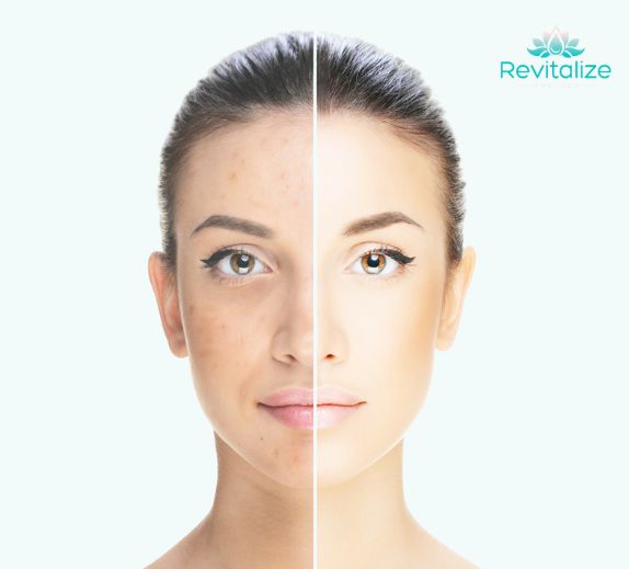 Chemical peel before and after