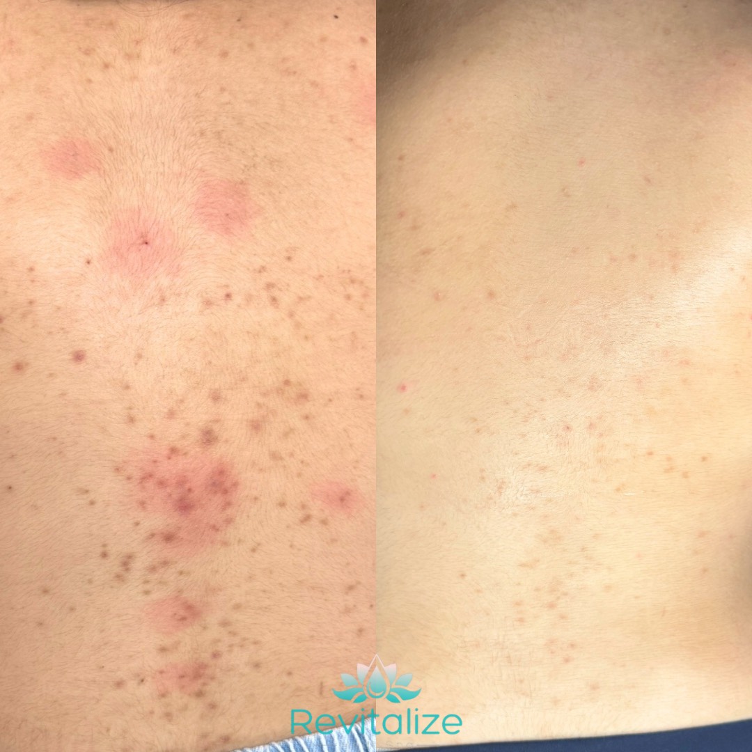 Before and After Image: Acne Clearing - front