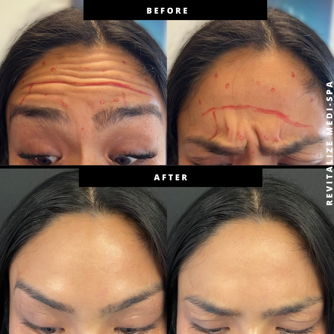 Before and After Image: Dysport - front