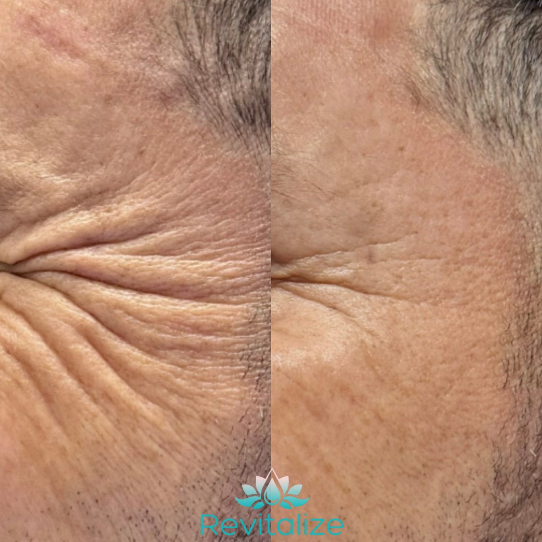 Before and After Image: Botox - left-side