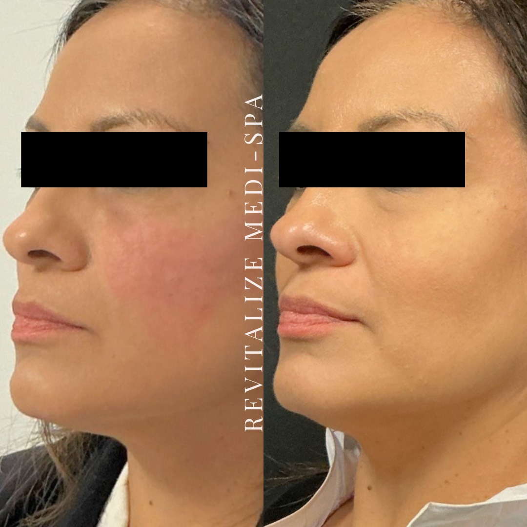 Before and After Image: Cheek Filler - left-front-oblique