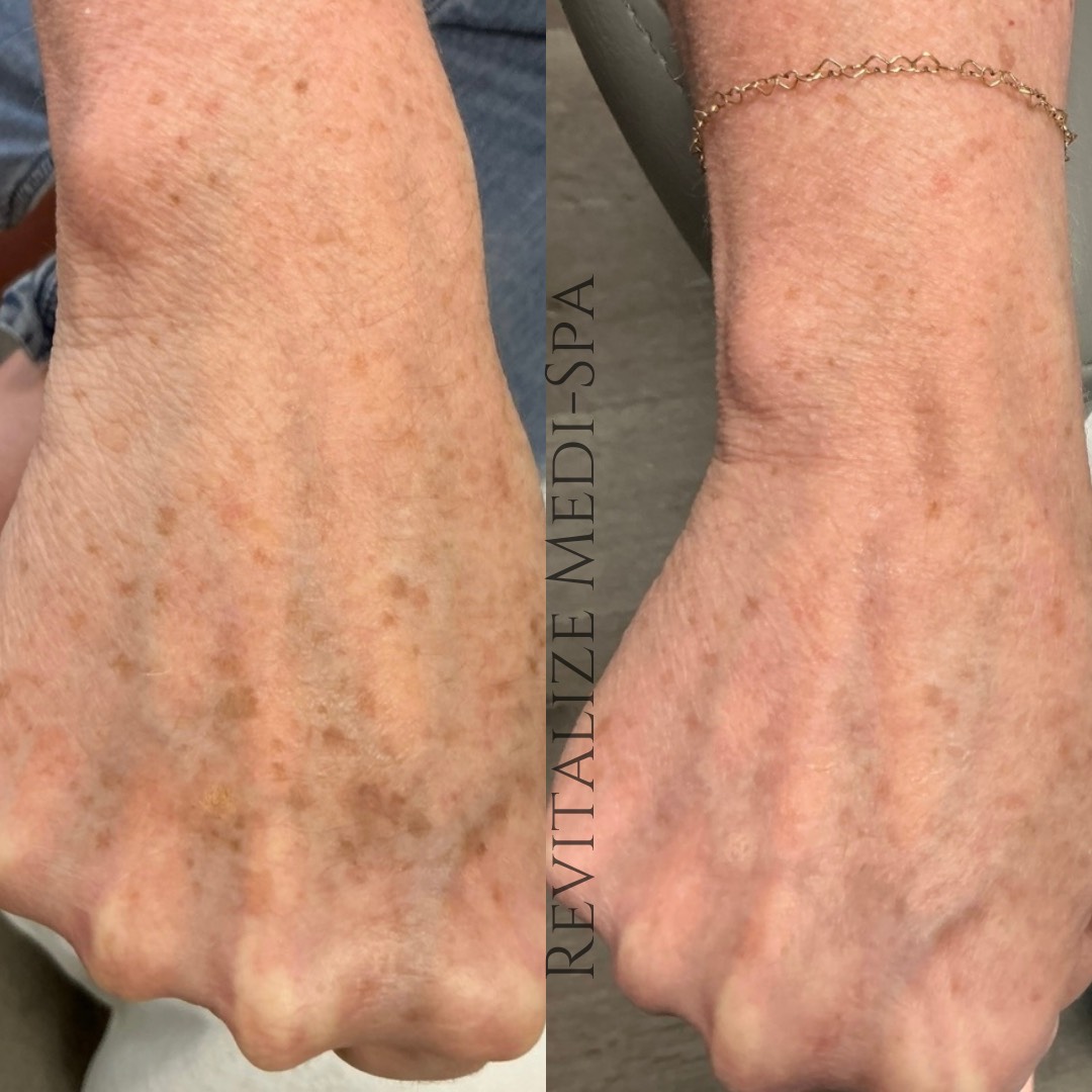 Before and After Image: IPL - front