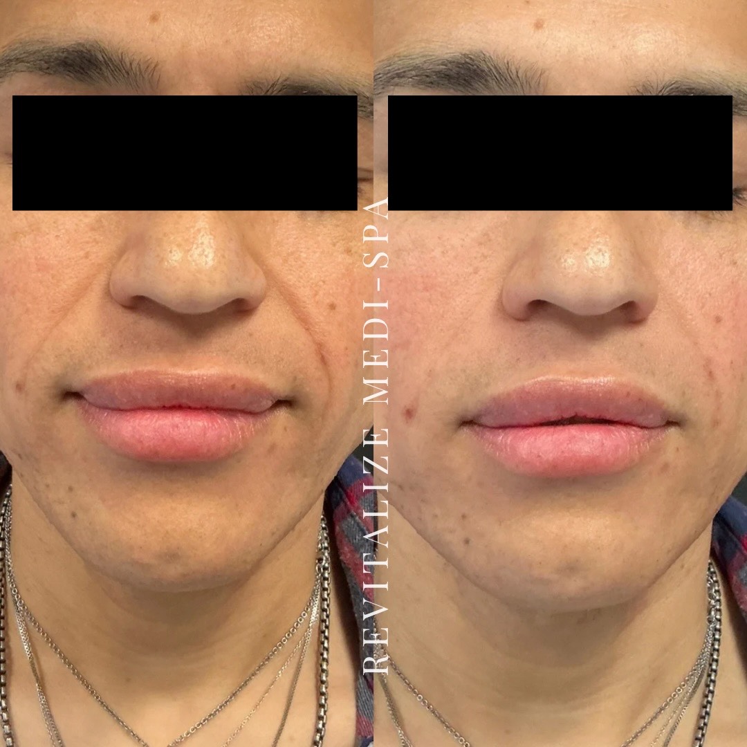 Before and After Image: Lifting Threads - front