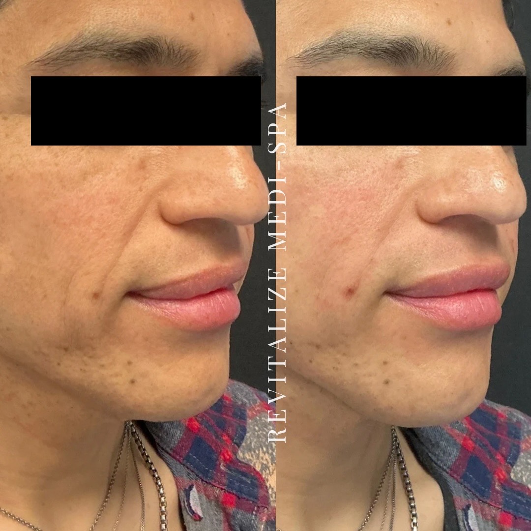 Before and After Image: Lifting Threads - right-front-oblique