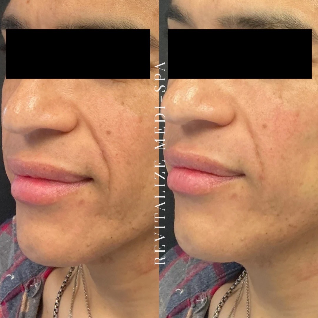 Before and After Image: Lifting Threads - left-front-oblique