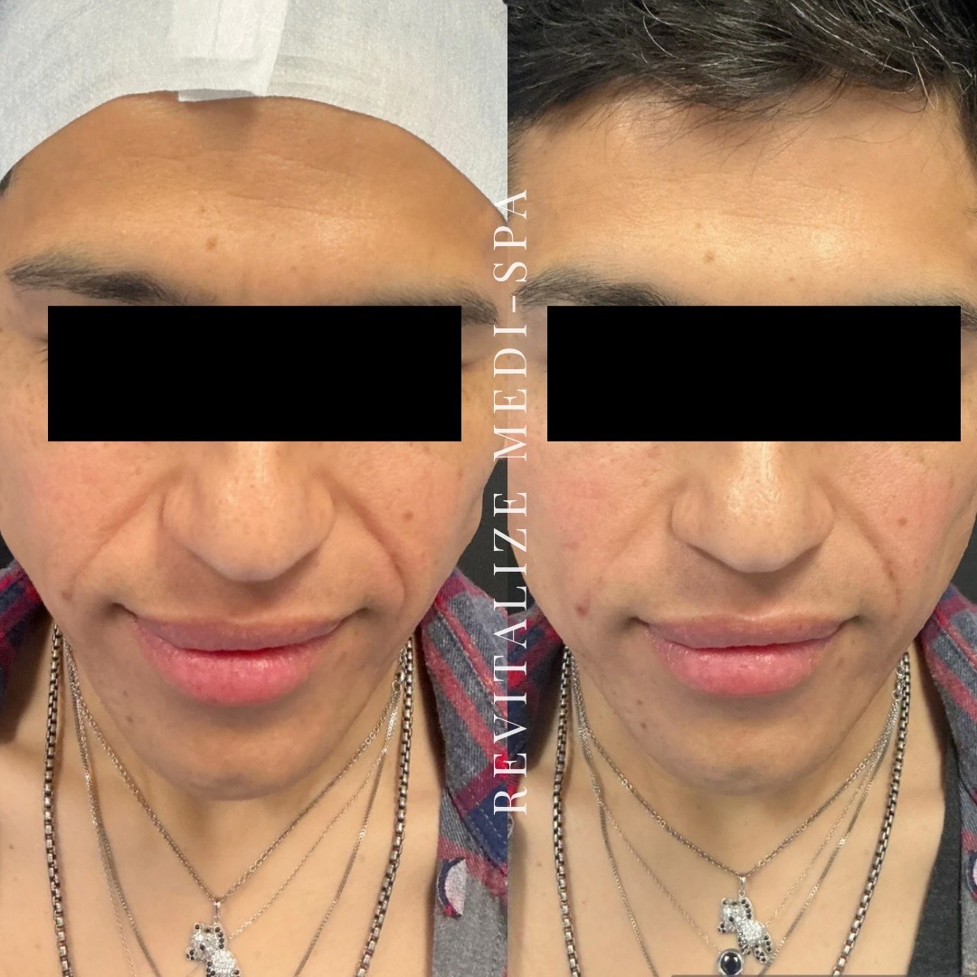 Before and After Image: Lifting Threads - front