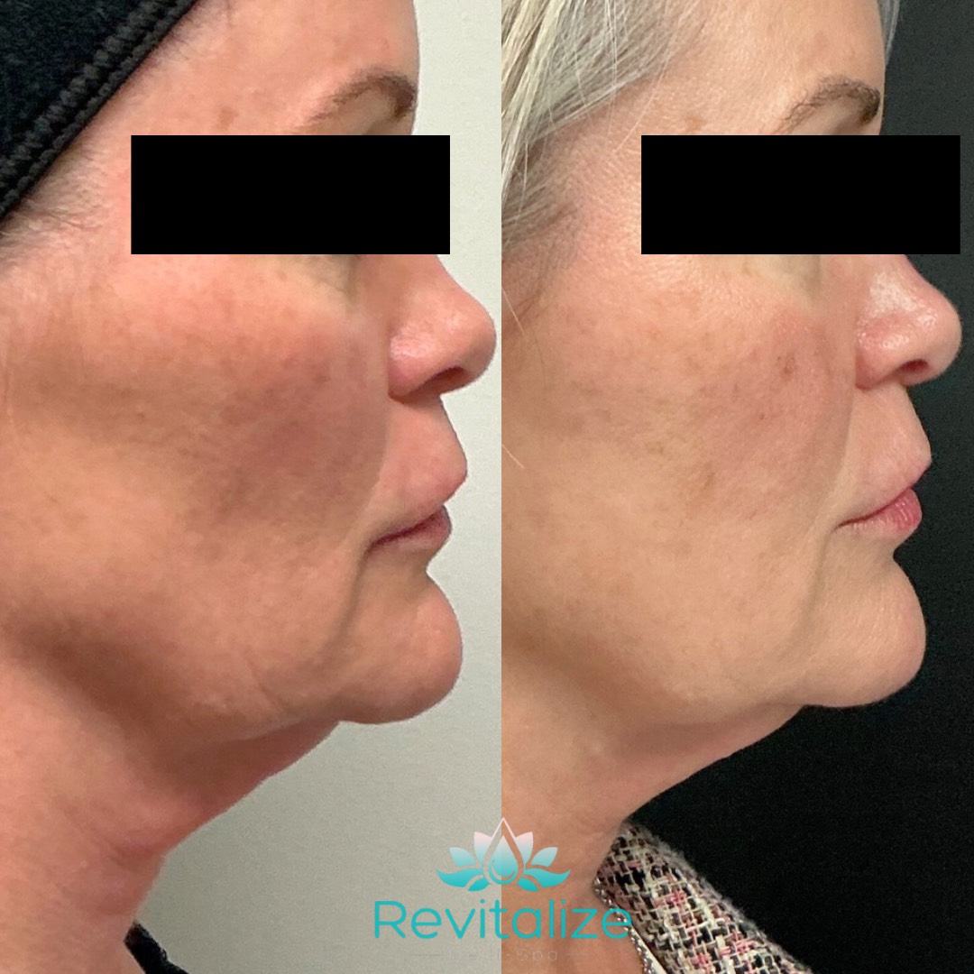 Before and After Image: Lifting Threads - right-side