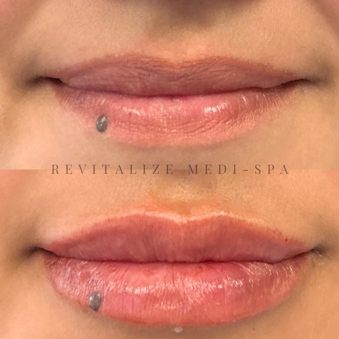 Before and After Image: Lip Filler - front