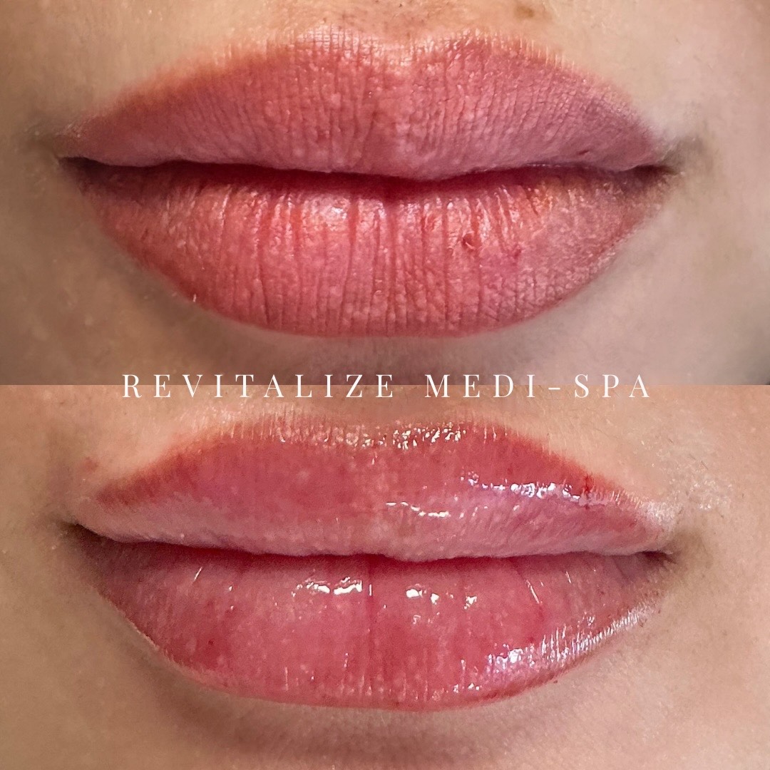 Before and After Image: Lip Filler - front