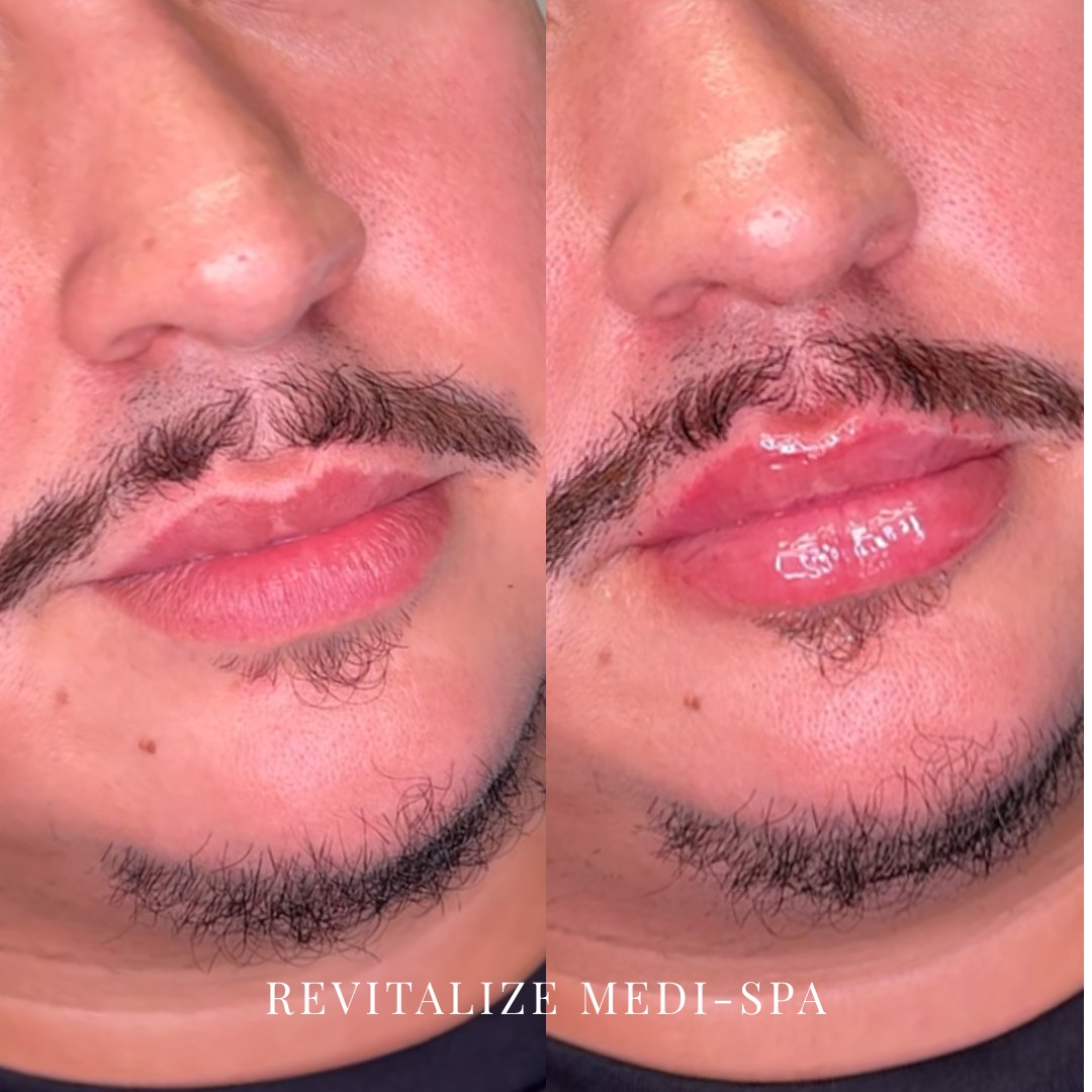 Before and After Image: Lip Filler - right-front-oblique