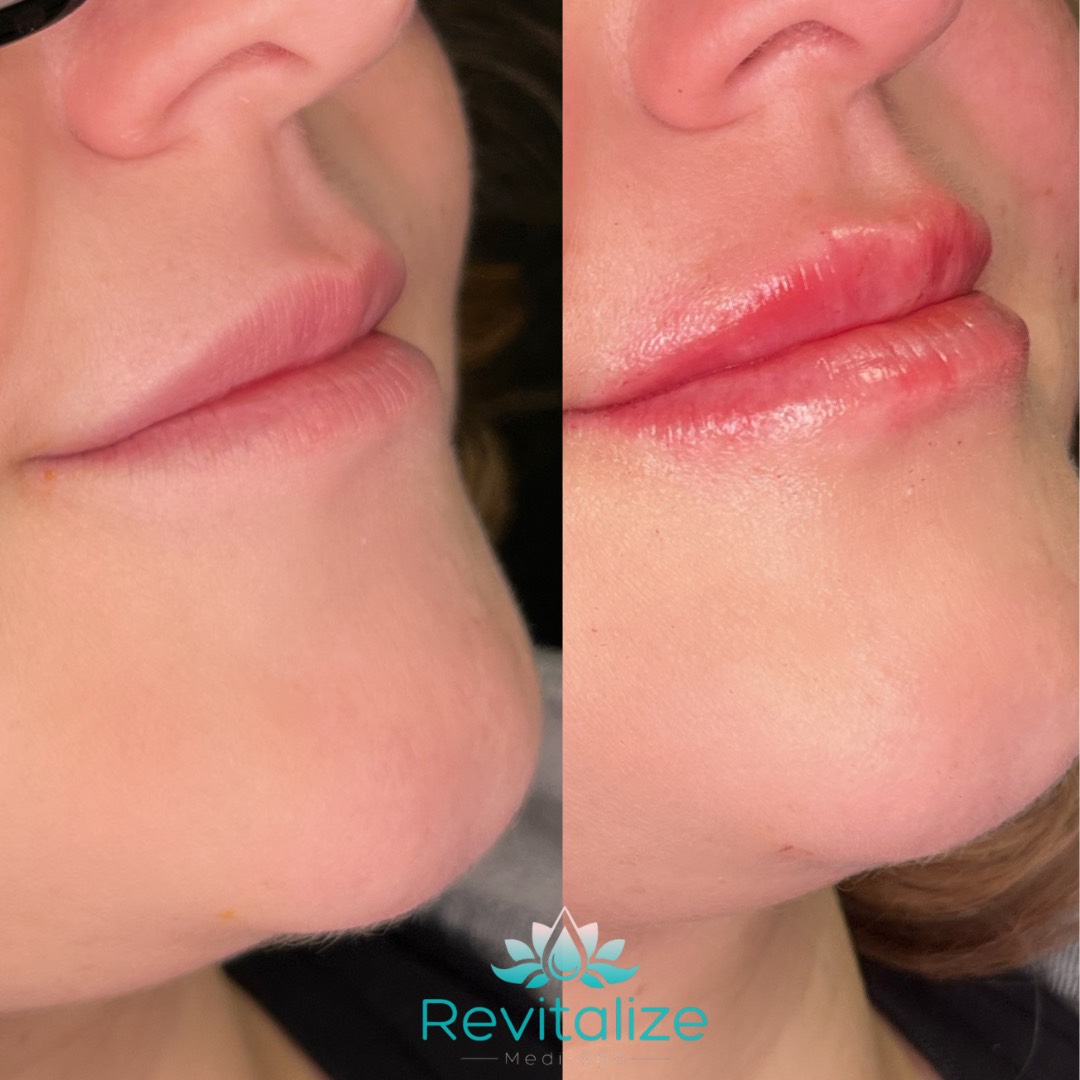 Before and After Image: Lip Filler - right-front-oblique