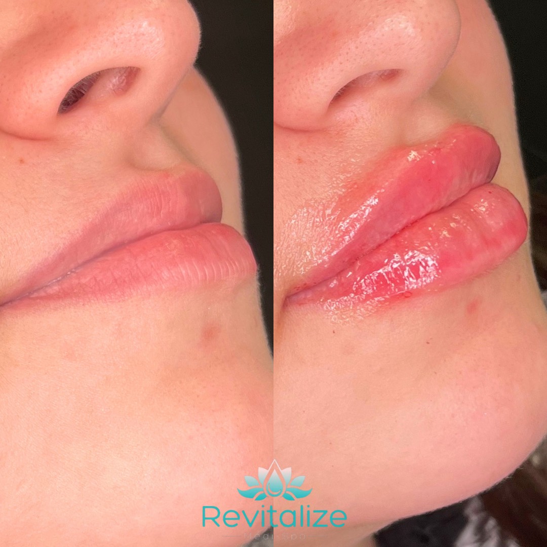 Before and After Image: Lip Filler - right-front-oblique