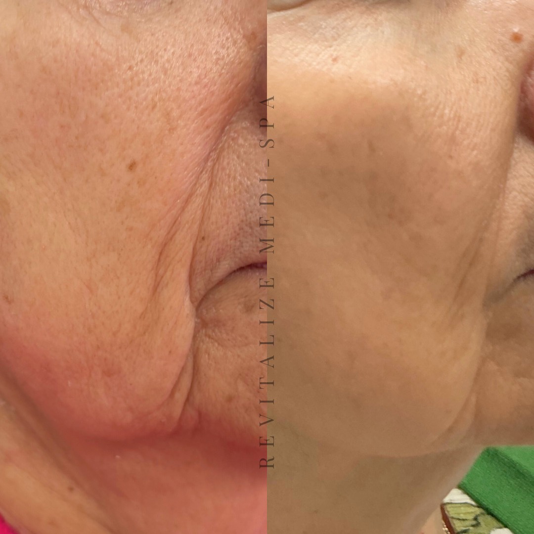 Before and After Image: Microneedling - right-side