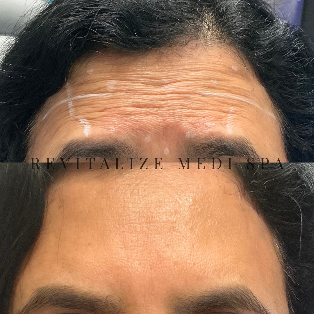 Before and After Image: Botox - front
