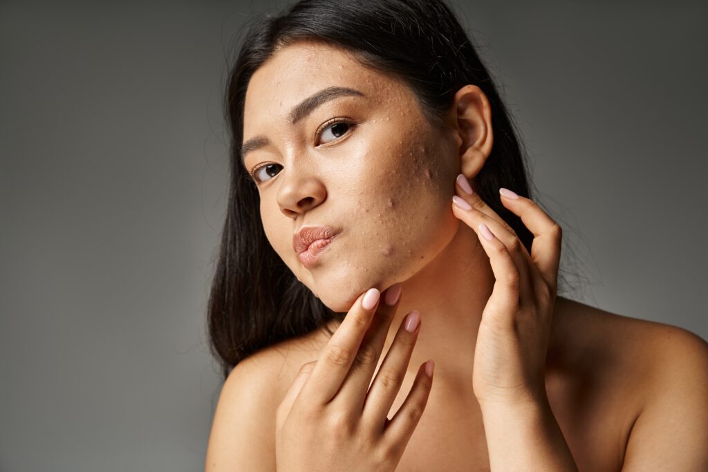 Young woman with bare shoulders touching acne-prone skin on gray background, concept of skincare, acne treatment, and dermatology
